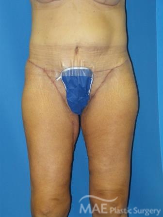 Thigh Lift Surgery, Chicago, IL