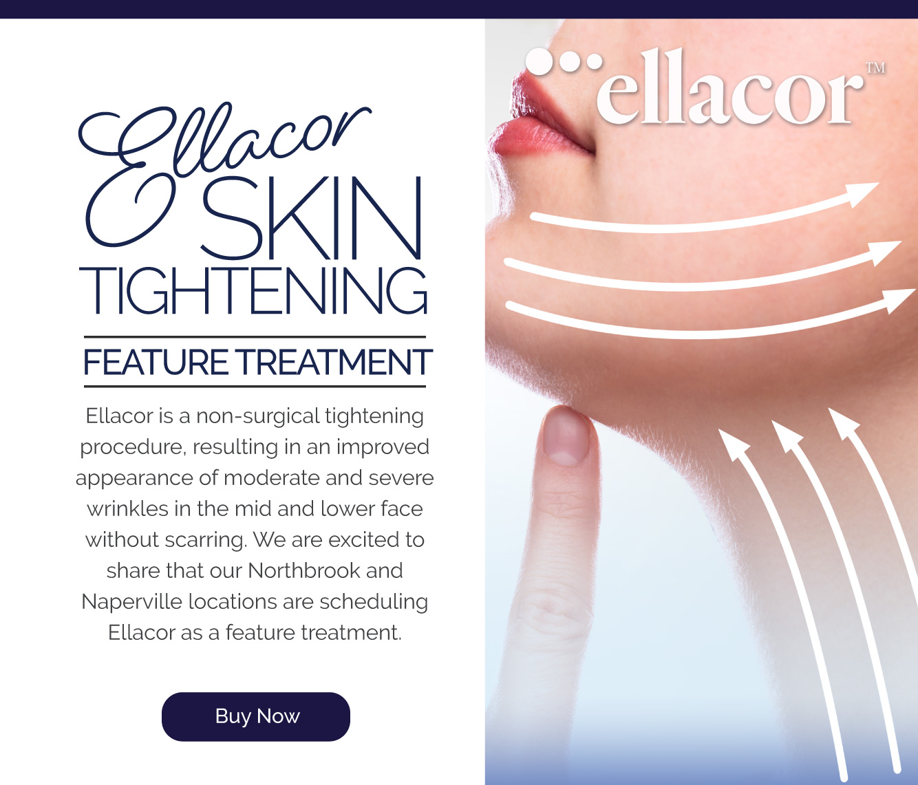 FEATURE TREATMENT: Ellacor Skin Tightening