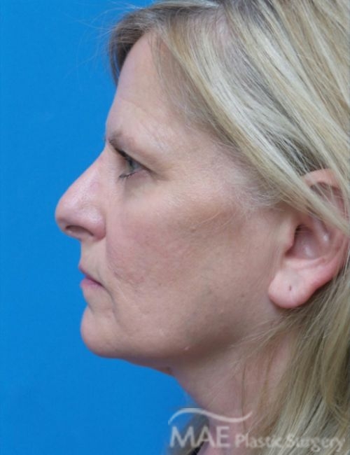 Nostrils Uneven After Rhinoplasty What To Do Mae Plastic Surgery