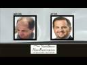 Hair Restoration with Chicago Plastic Surgeon